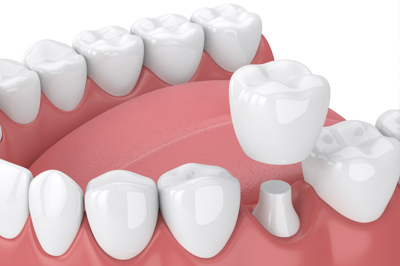 Dental Crowns in Yonkers