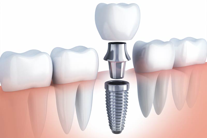 Implants Dentist in Yonkers
