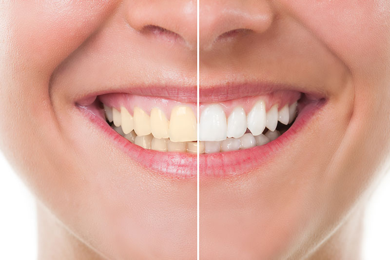 Teeth Whitening in Yonkers