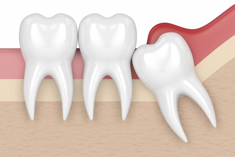 Wisdom Tooth Removal in Yonkers